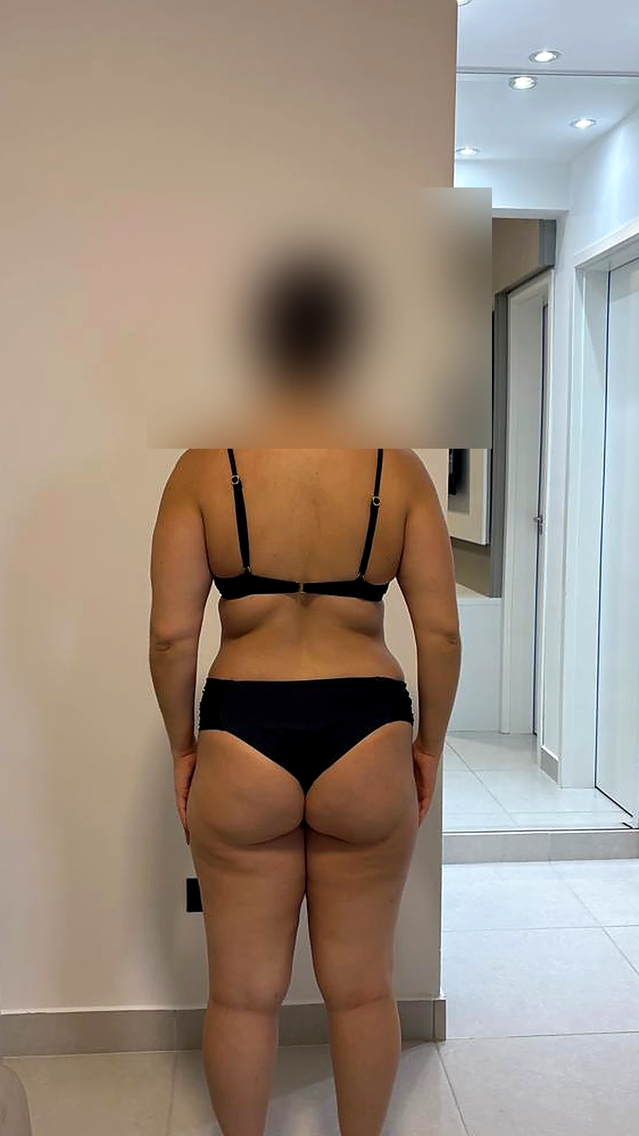 Evolução 2, ângulo posterior, depois do acompanhamento